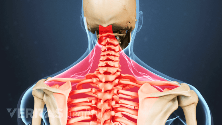 An illustration showing a adult spine with muscles of neck and upper back highlighted in red.
