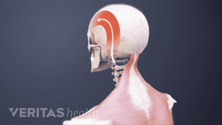 illustration showing occipital neuralgia pain.