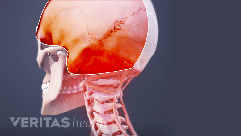 Illustration showing migraine headache.