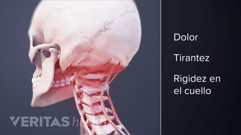 Síntomas que afectan el cuello.