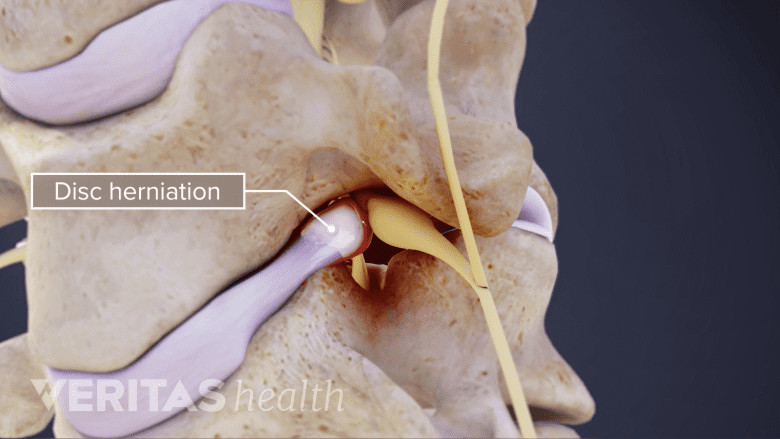 Sagittal rendering of a herniated cervical disc pressing on the nerve.