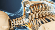 Medical illustration of a cervical selective nerve root block