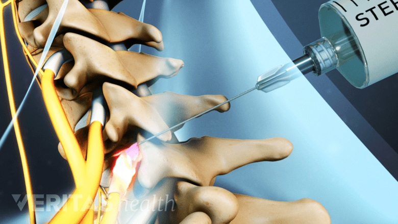 Medical illustration showing cervical spine and a needle injected into it.