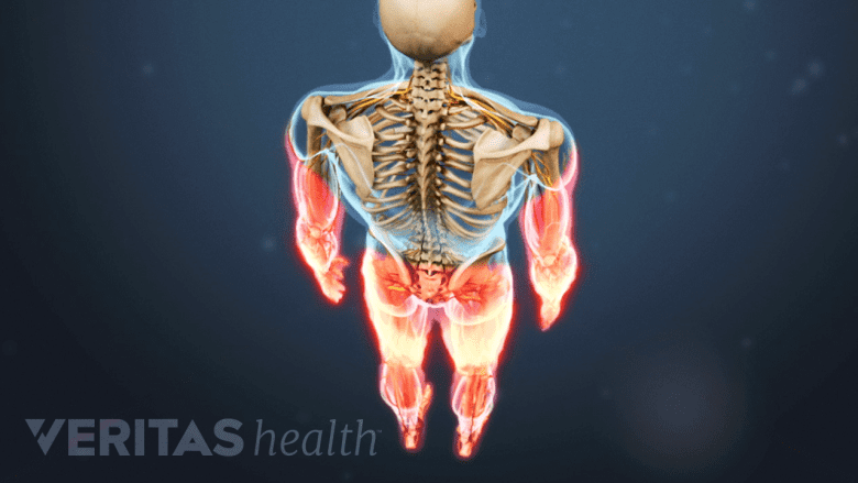 An illustration showing both limbs highlighted in red.