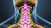 Posterior view of the cervical spine showing spinal stenosis.