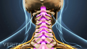 Posterior view of the cervical spine showing spinal stenosis.