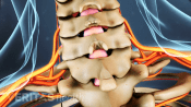 Posterior view of herniated disc in the cervical spine.