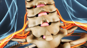 Posterior view of herniated disc in the cervical spine.