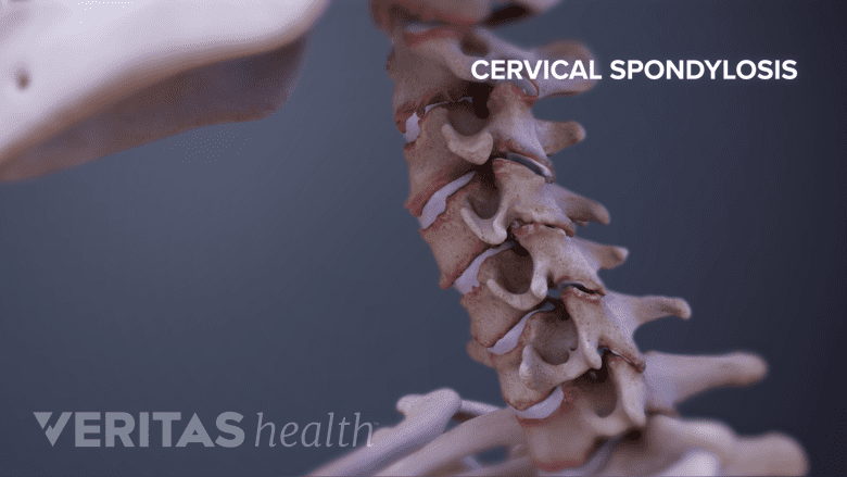 Medical illustrtion shopwing cervical spondylosis.
