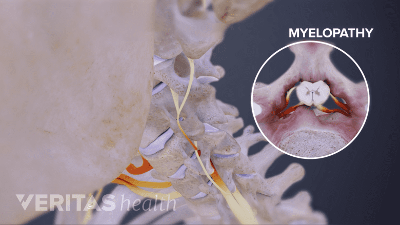 Illustration showing cervical myelopathy.