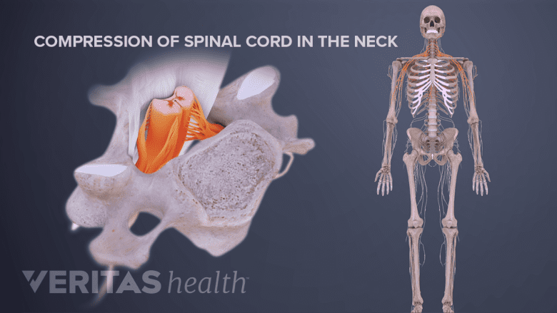 Illustration showing a skeleton with neck and shoulder highlighted in red and cervical vertebra showing spinal cord compression.
