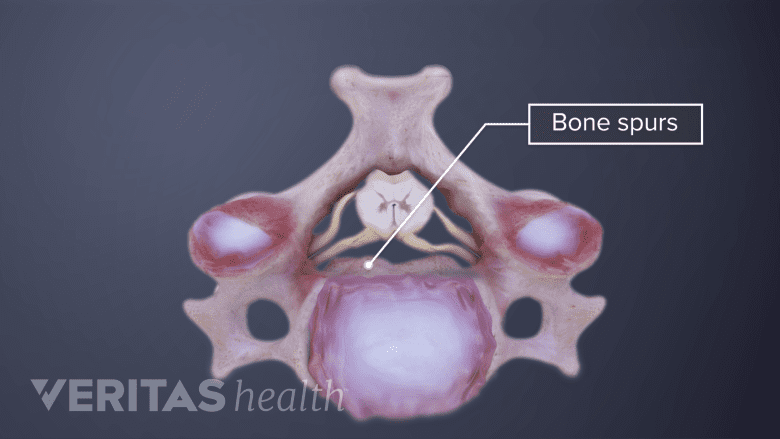 Medical illustration showing cervical vertebra with a bone spur.