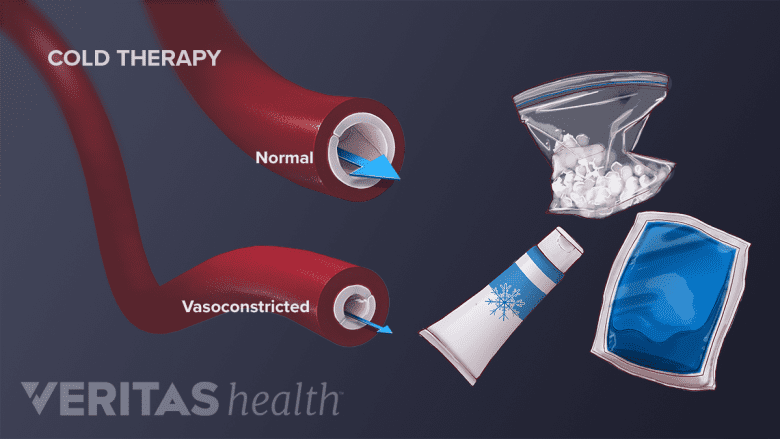 An illustration showing various types of cold therapy.
