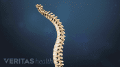 Curvature of the spine showing Scheuermann's Disease