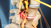 Profile view of degenerative disc disease in the lumbar spine
