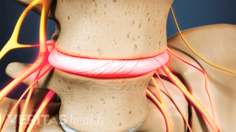 Degenerated spinal disc causing nerve compression.