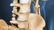 Anterior view of degenerative spondylolisthesis in the lumbar spine.