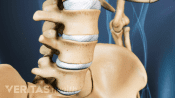Anterior view of degenerative spondylolisthesis in the lumbar spine.