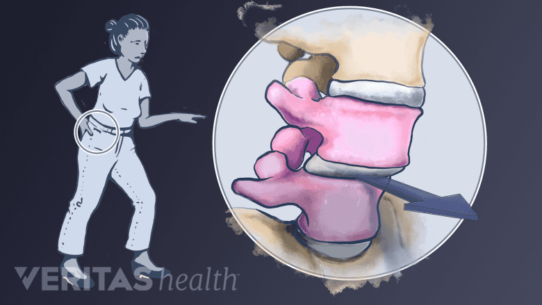 One vertebra slips forward over the vertebra below it.