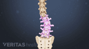 Medical illustration of the lumbar spine showing signs of a scoliosis curve