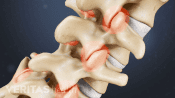 Vertebrae of the spine showing pain at the facet joints