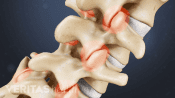 Vertebrae of the spine showing pain at the facet joints