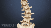 Posterior view of curvature in the lower spine from degenerative scoliosis.