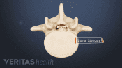 Medical illustration of degenerative spinal stenosis