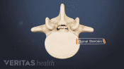 Medical illustration of degenerative spinal stenosis