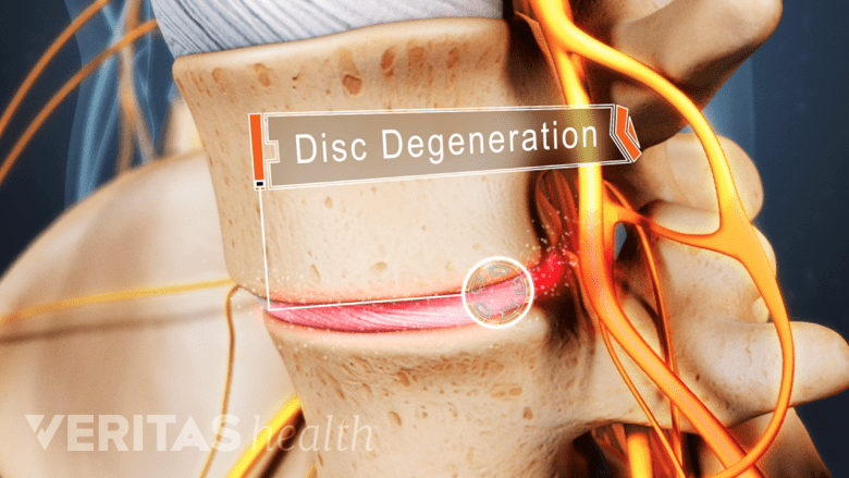 Profile view of lumbar spine showing disc degneration.