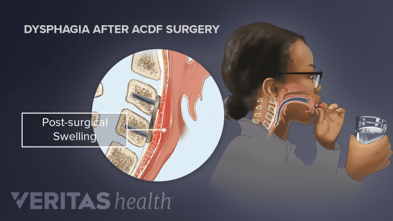 Illustration showing cross section of cervical spine with a woman holding a glass of water.