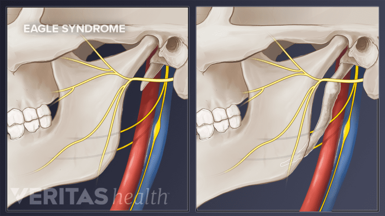 Illustration comparing a normal vs elongated styloid process.