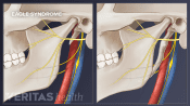 Illustration comparing a normal vs elongated styloid process.