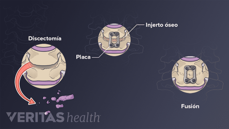 Pasos de un procedimiento de discectomía y fusión cervical anterior.