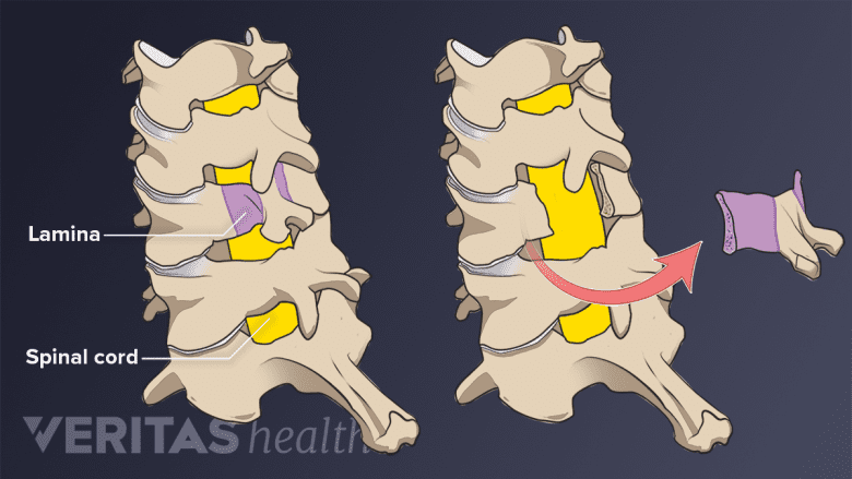 Illustration showing cervical laminectomy procedure.