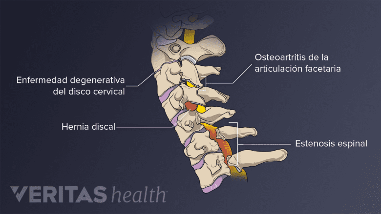 Varios problemas que pueden afectar la columna vertebral.