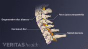 Medical illustration of common problems affecting the cervical spine. Degenerative disc disease, facet joint osteoarthritis, herniated disc, and spinal stenosis are highlighted.