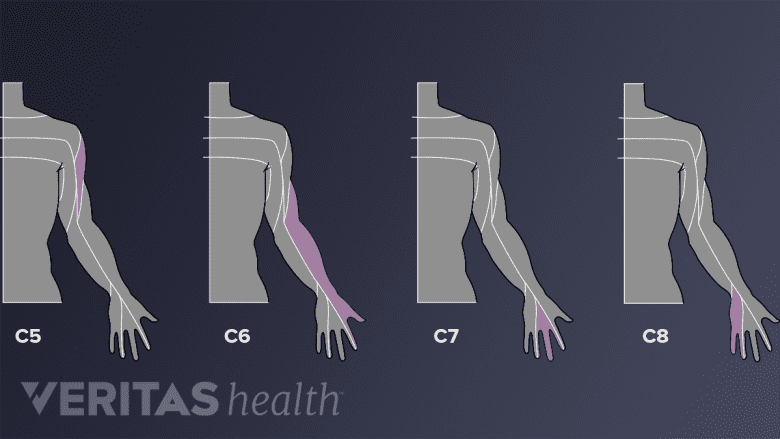illustration of the cervical dermatomes affected by cervical radiculopathy