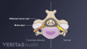 Illustration of nerve root inflammation from cervical foraminal stenosis, the common cause of cervical radiculopathy