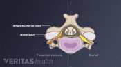 Illustration of nerve root inflammation from cervical foraminal stenosis, the common cause of cervical radiculopathy
