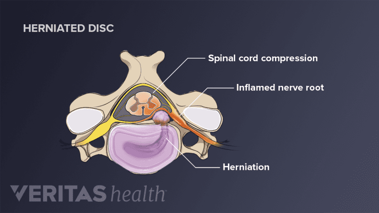 A herniated disc in the neck compressing the spinal cord and nerve root.