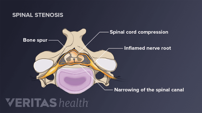 Spinal cord in the neck being compressed by a bone spur.
