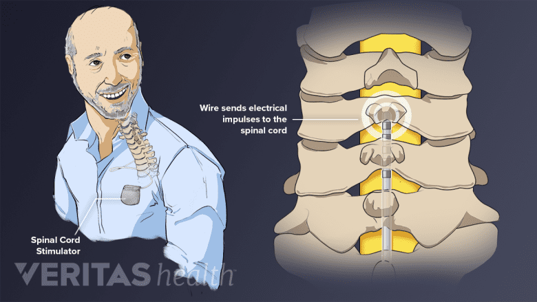 A man with a stimulator in his pocket and cervical spine with a wire inserted.