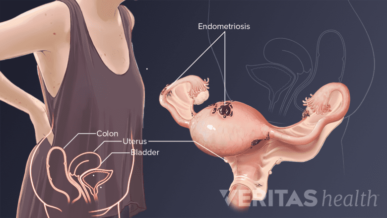 Medical illustration of endometriosis