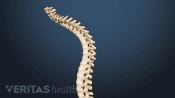 Spine illustrating curvature from kyphosis