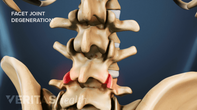 Illustration showing lumbar spine with facet joint highlighted in red.