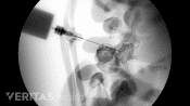 Xray image of a facet joint injection.