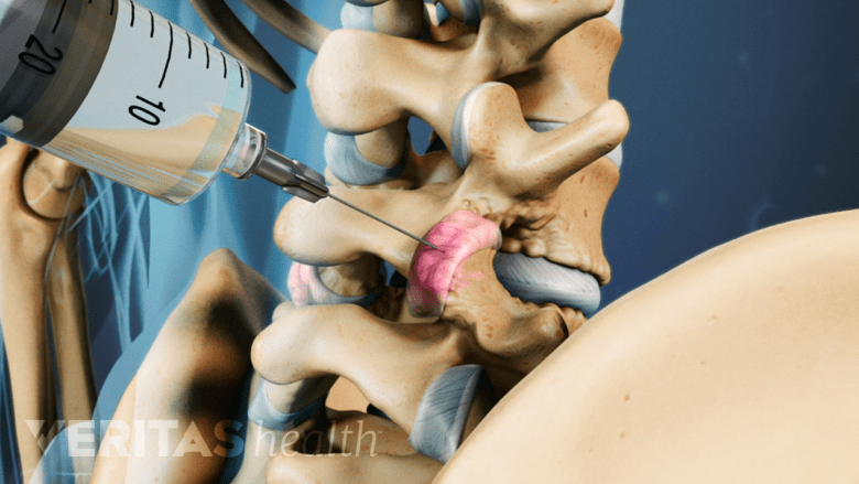 A needle injected into the facet joint.