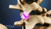Facet joint highlighted between two vertebra.