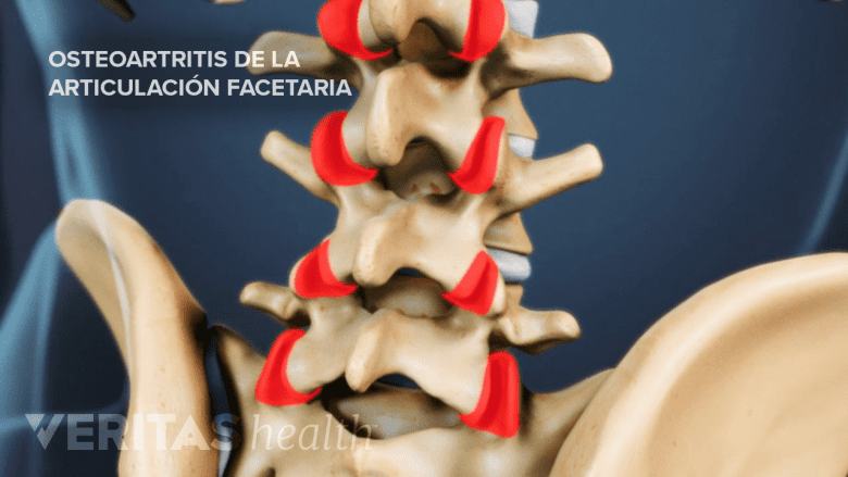 Osteoartritis de las articulaciones facetarias.